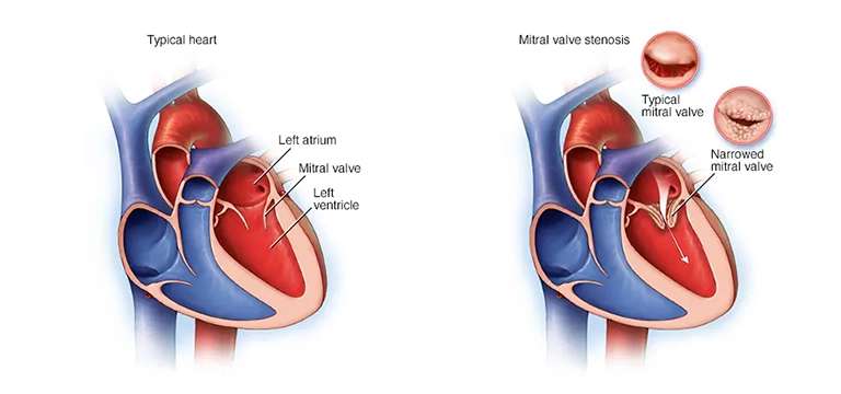 Mitral Stenosis : All you must know about It